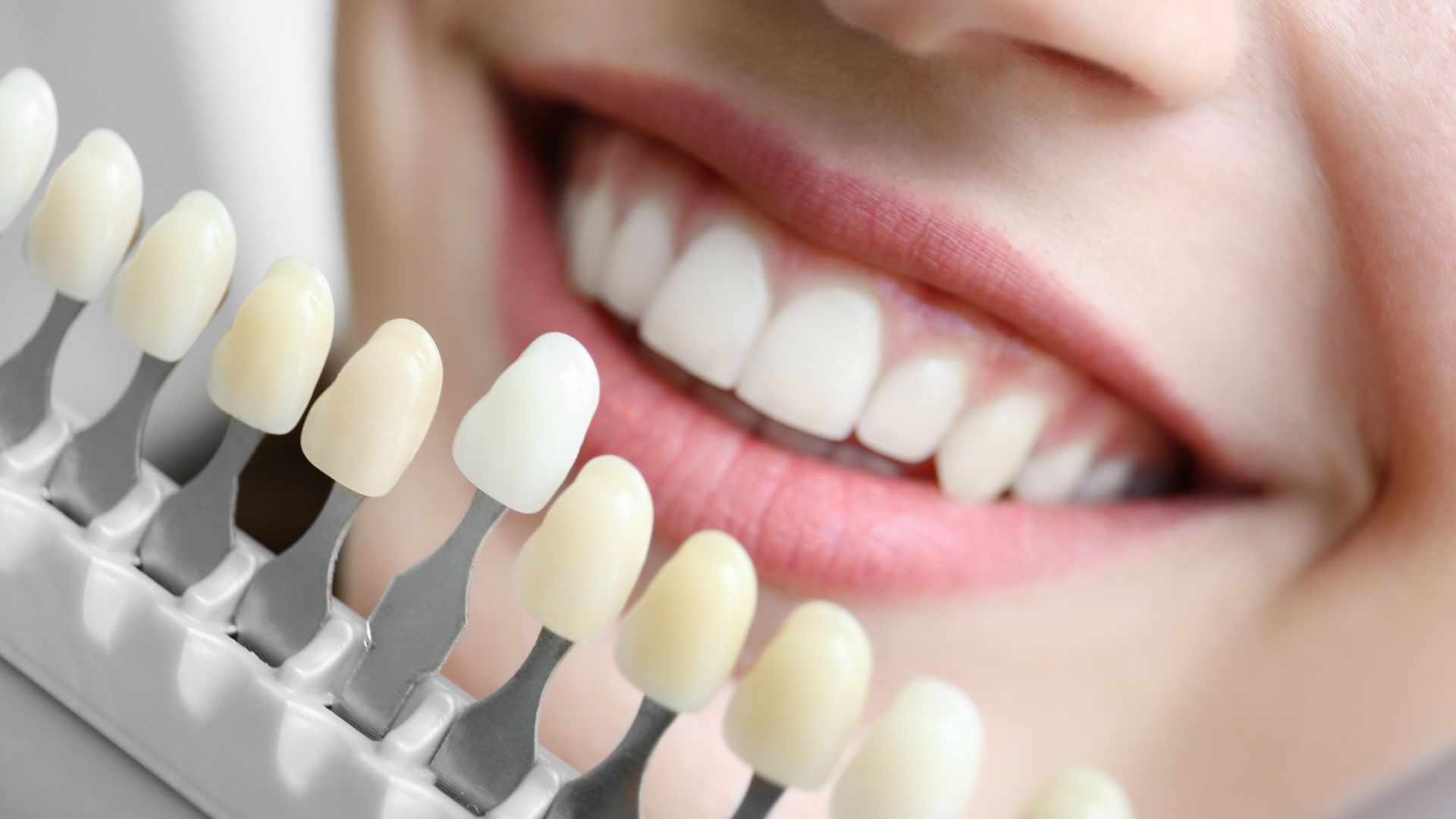 What Teeth Whitening in Playa Vista Can Help Improve