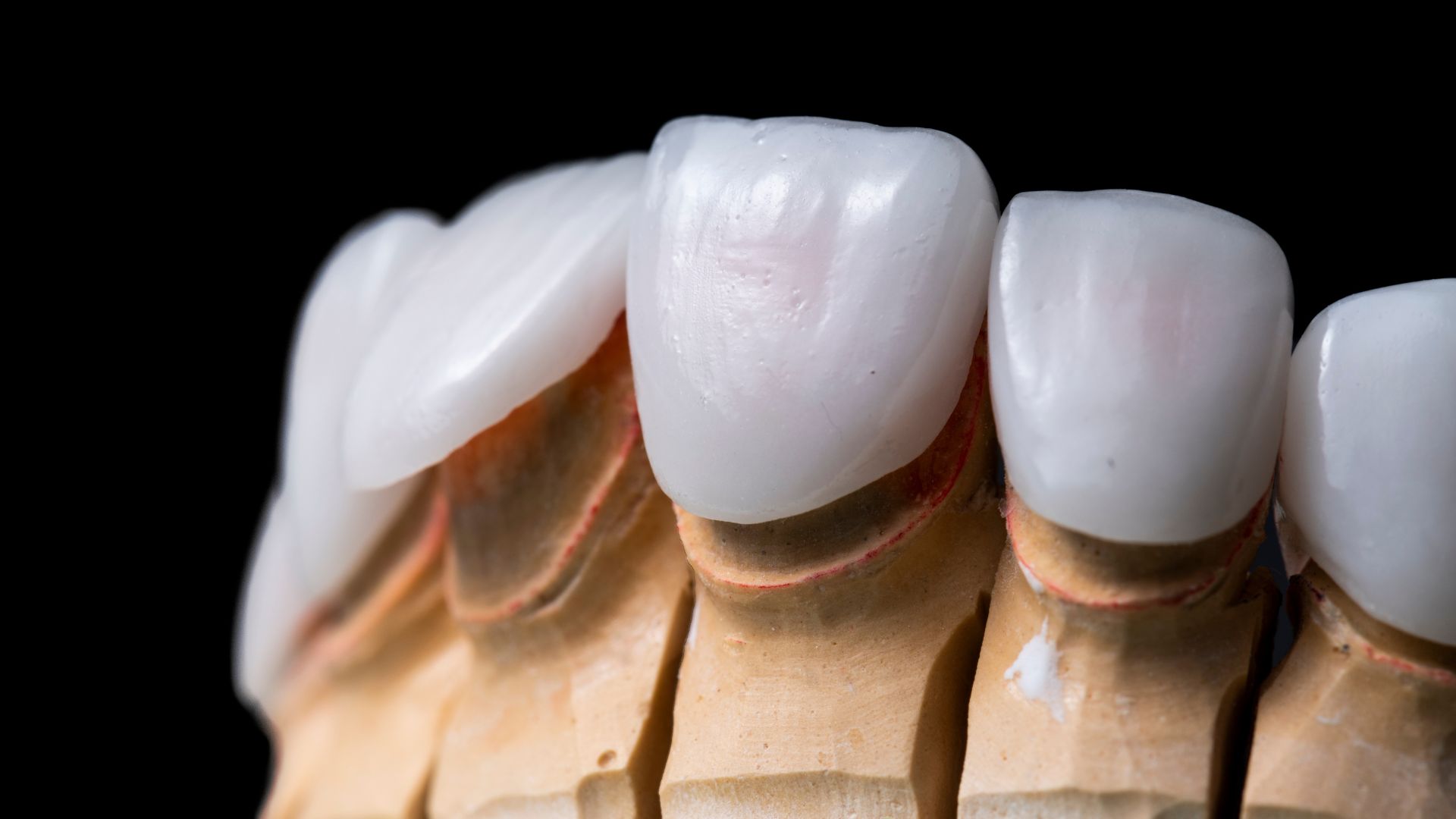 Schedule a Visit for Composite Veneers in Playa Vista Image