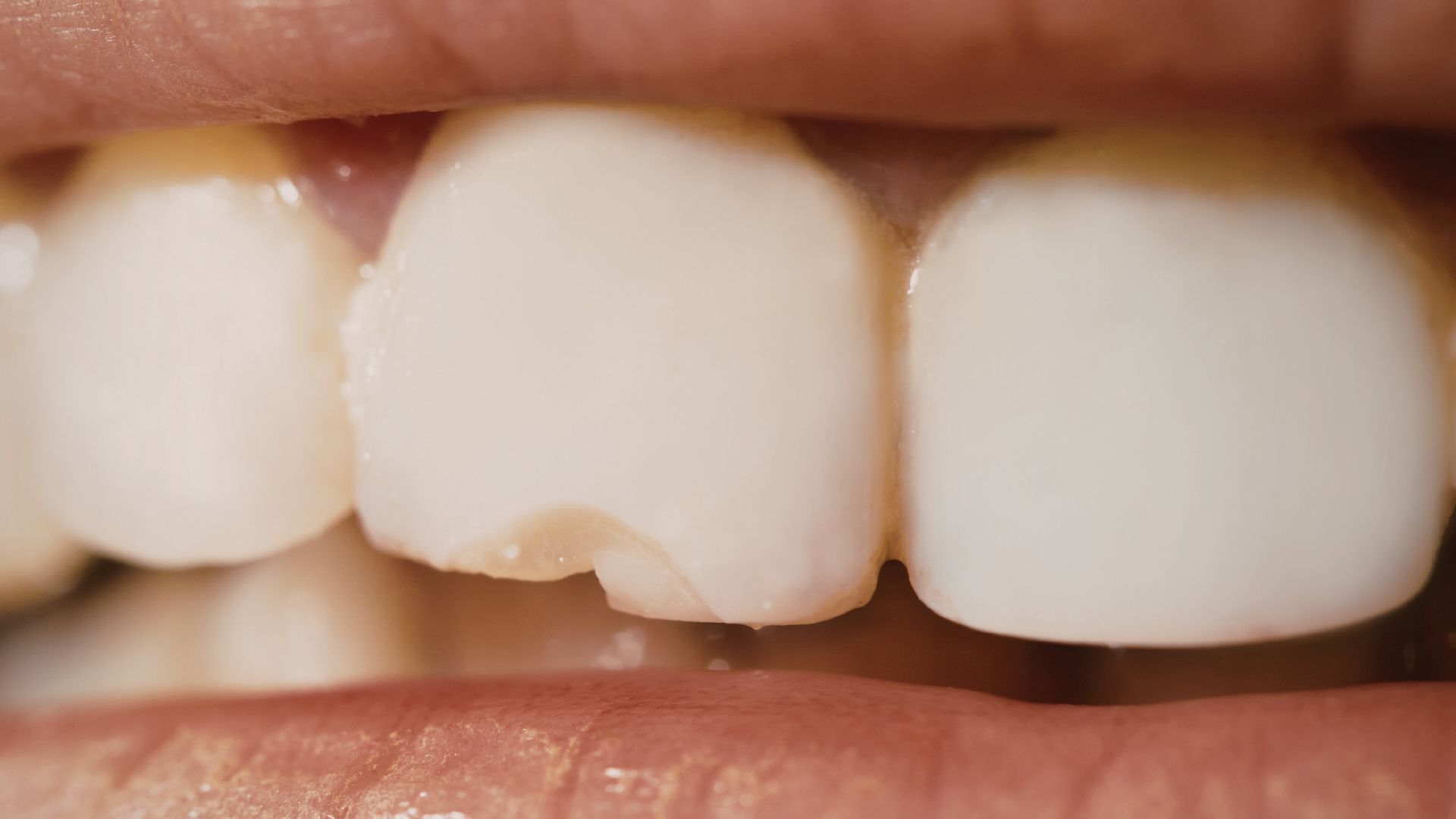 Schedule Dental Bonding for Chipped Teeth in Playa Vista - Call Today Image