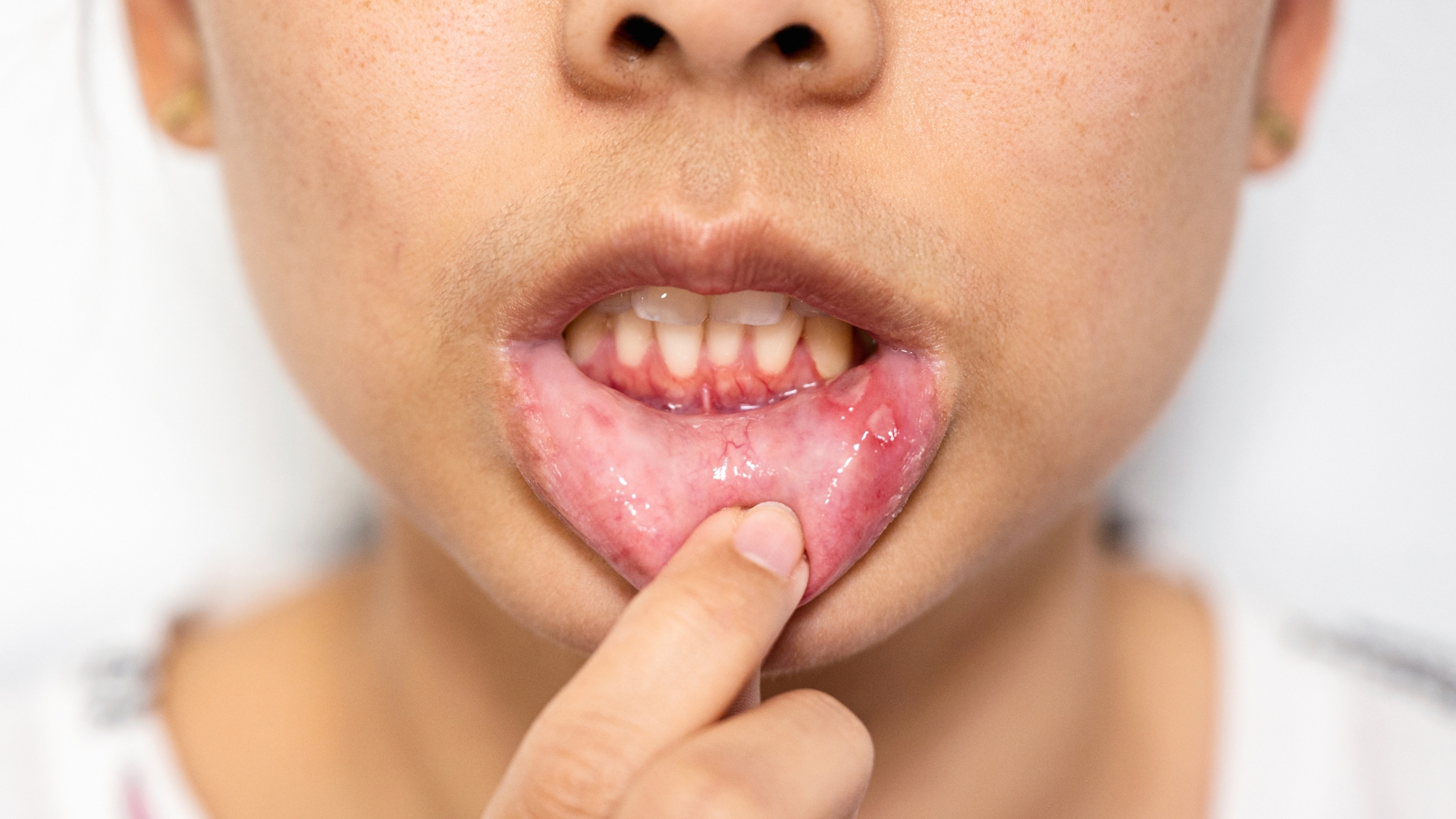 Faster Healing Starts With Modern Laser Dentistry for Mouth Sores in Playa Vista, CA image