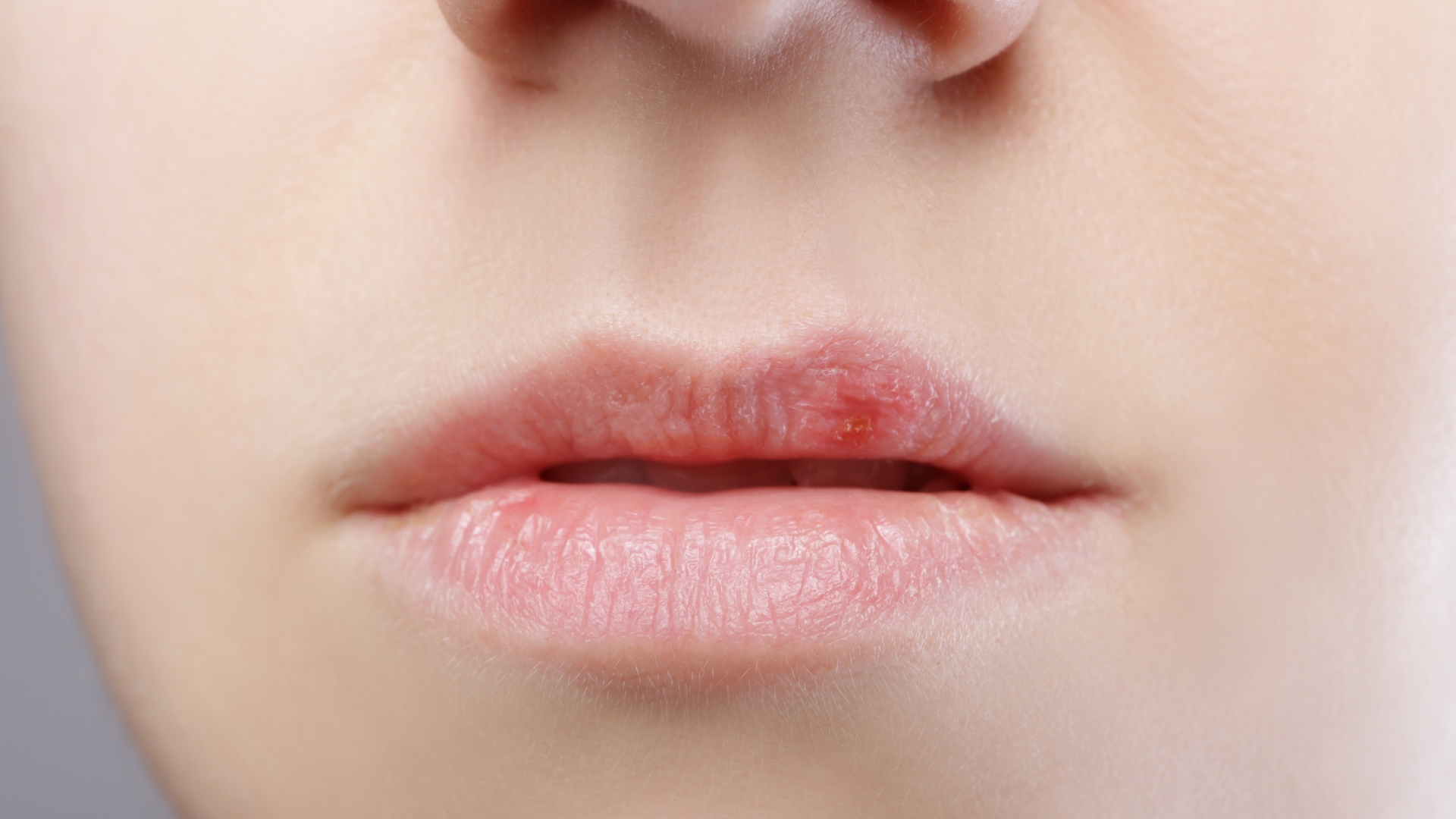 How Cold Sore Laser Treatment Helps Playa Vista Patients Heal More Comfortably image