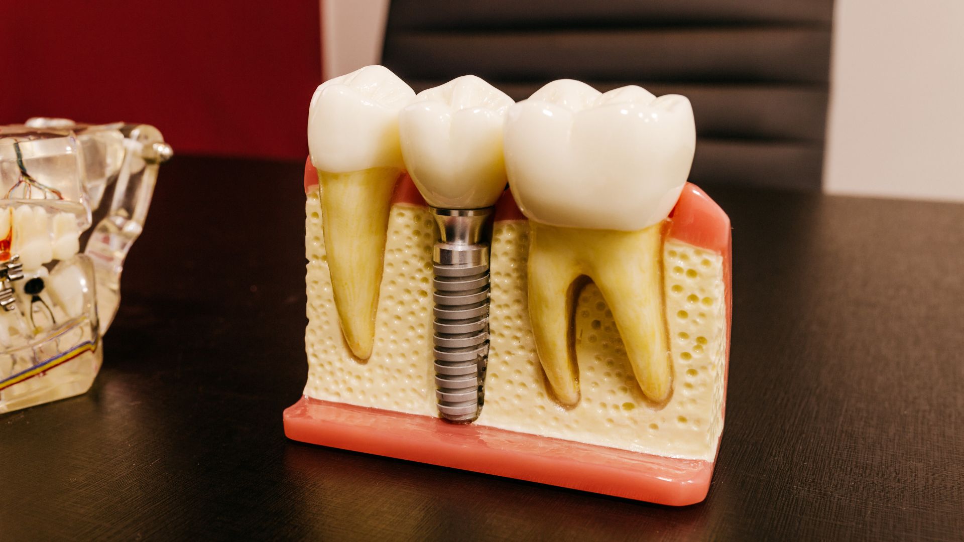 How Dental Bridges Help Replace Missing Teeth Without Removable Dentures