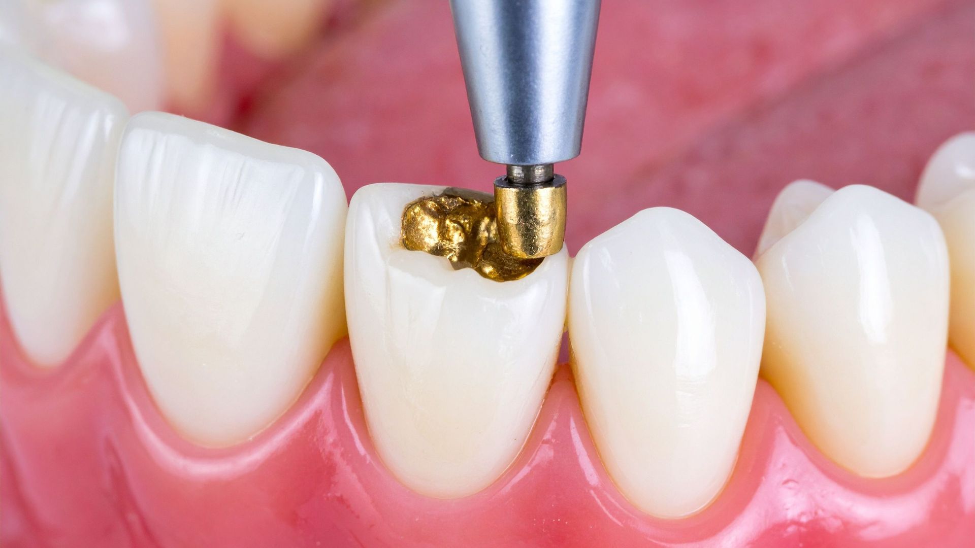 How Dental Fillings in Playa Vista Repair Cavities Before the Damage Spreads