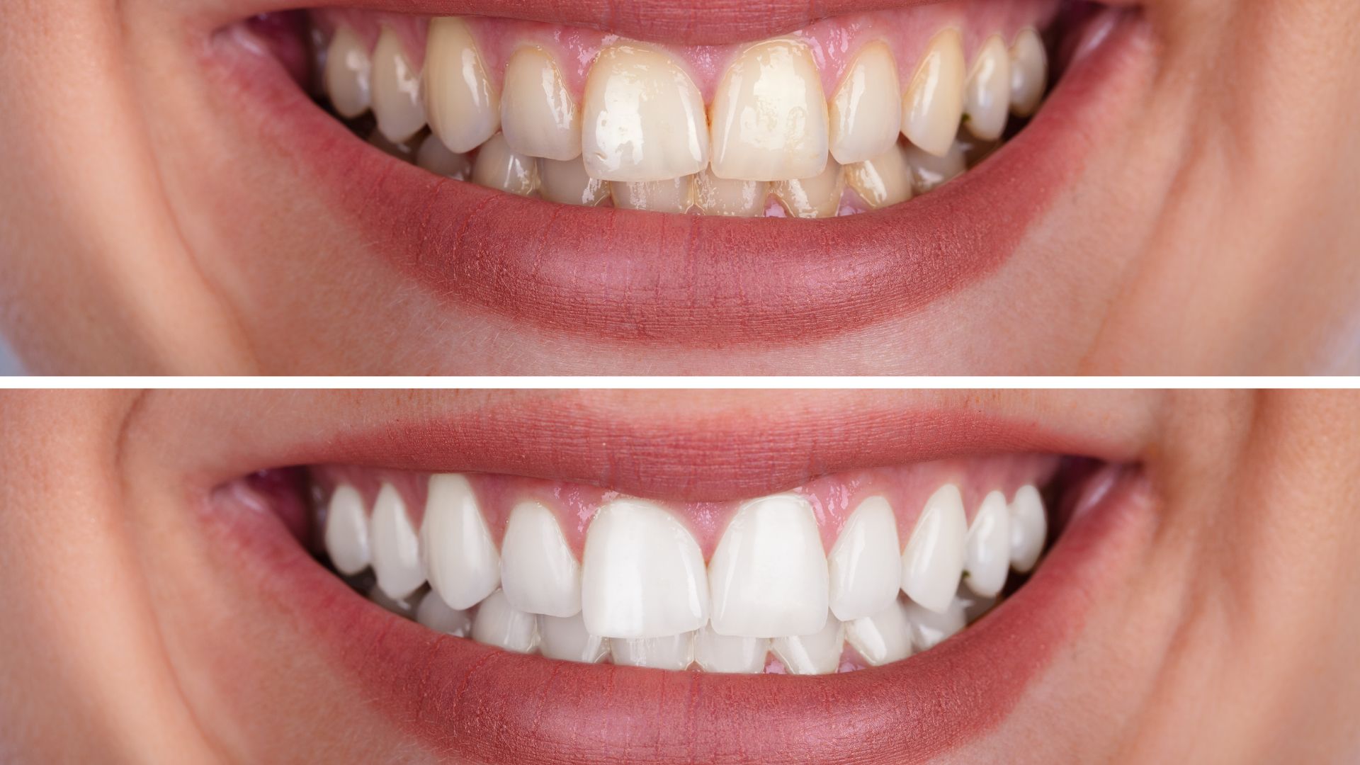 How Smile Discoloration Is Evaluated Before Teeth Whitening Treatment in Playa Vista