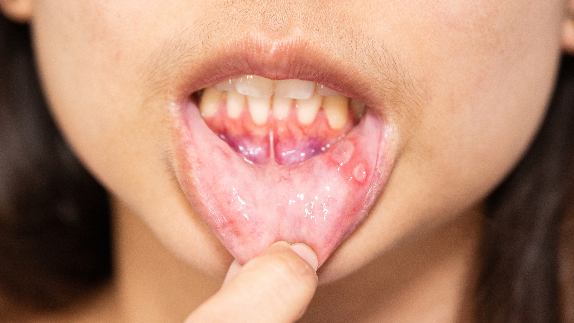 Laser Treatment for Cold and Canker Sores in Playa Vista - Visit Westside Aesthetic Dentistry Today