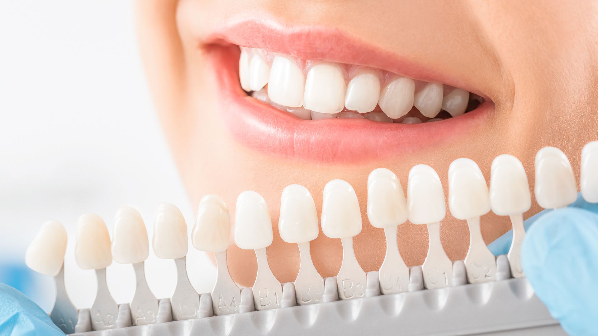Schedule Teeth Whitening in Mar Vista Today Image