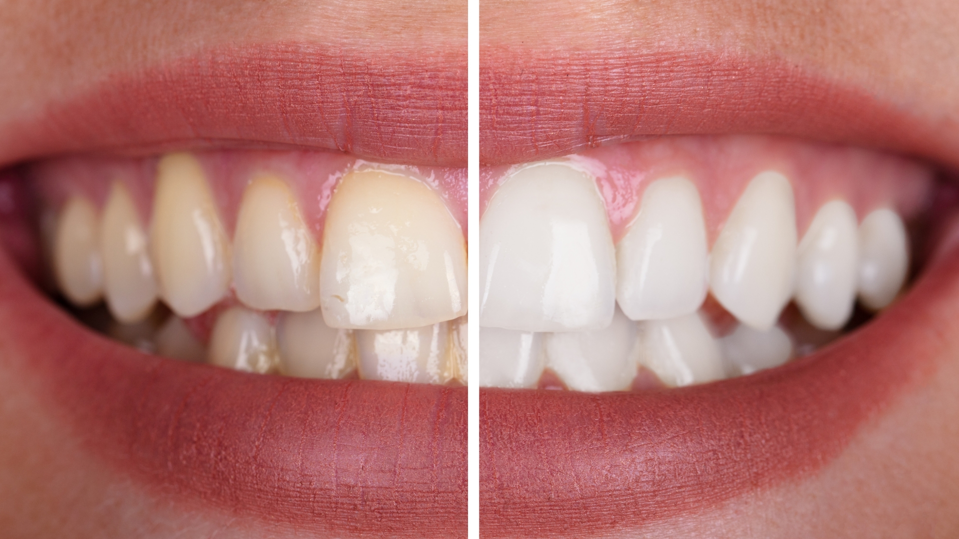 Teeth Whitening in Playa Vista - Visit Westside Aesthetic Dentistry Today