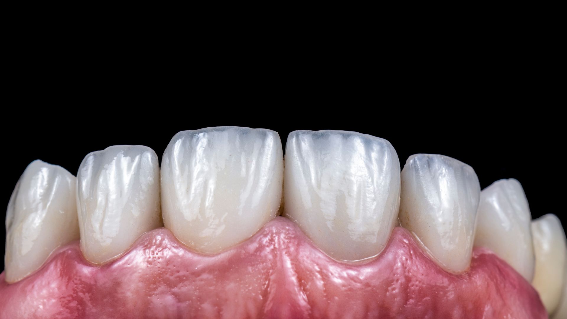 Schedule a Veneers for Worn Teeth in Playa Vista Visit by Contacting Us Today Image