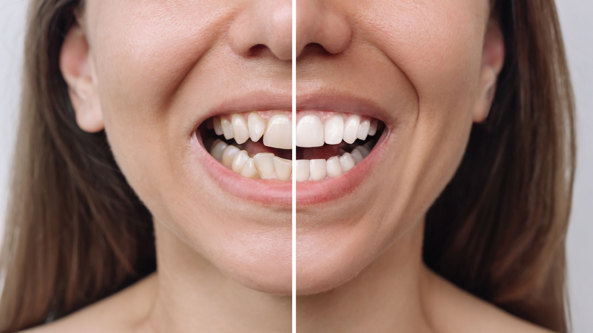 Schedule a Veneers Consultation in Mar Vista Image