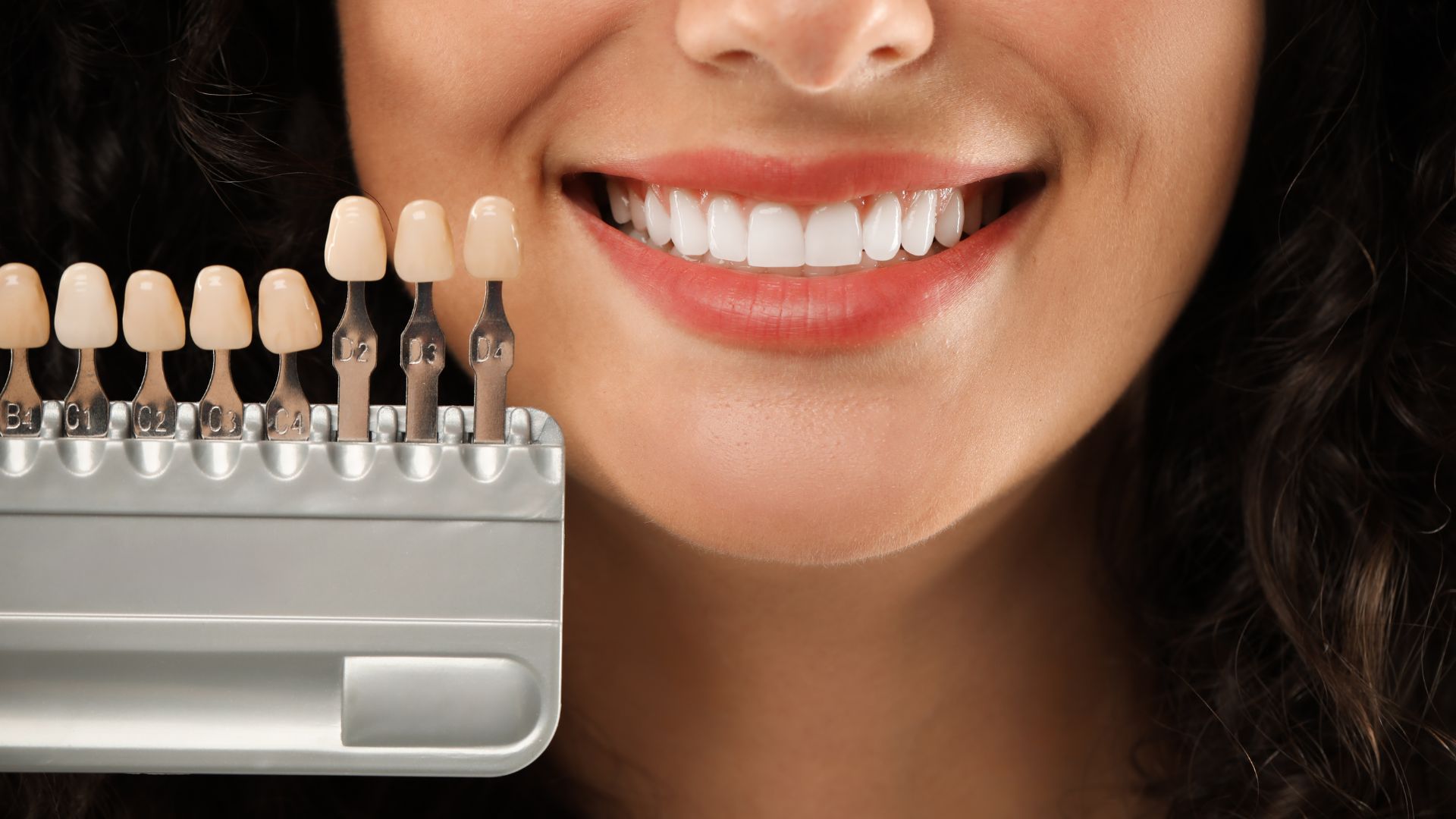 What Dental Veneers Can Fix for Common Smile Concerns Image