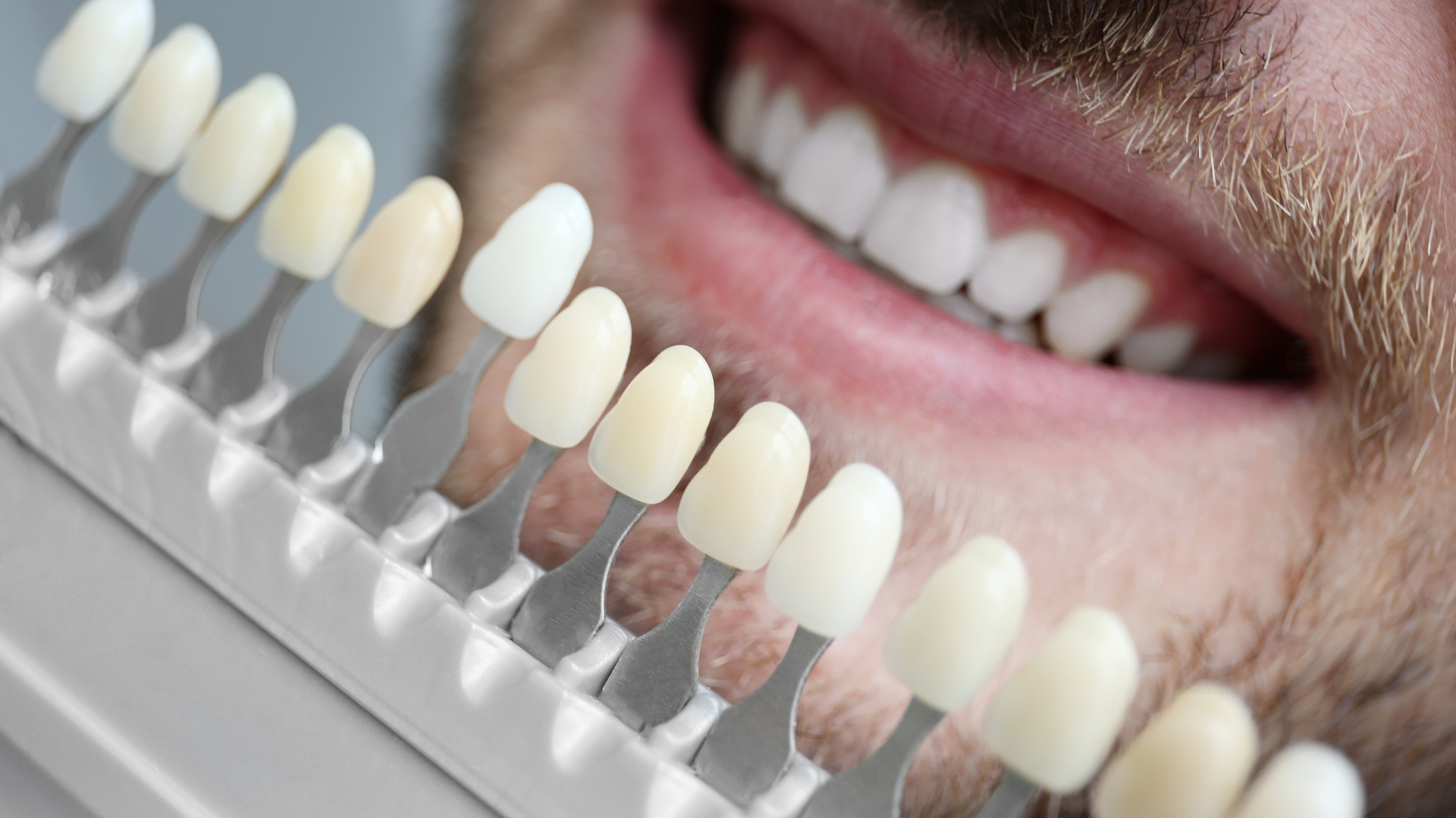 Veneers in Playa Vista - Visit Westside Aesthetic Dentistry Today