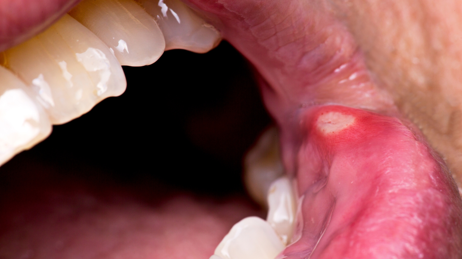 What Happens During Canker Sore Laser Treatment Near Playa Vista image