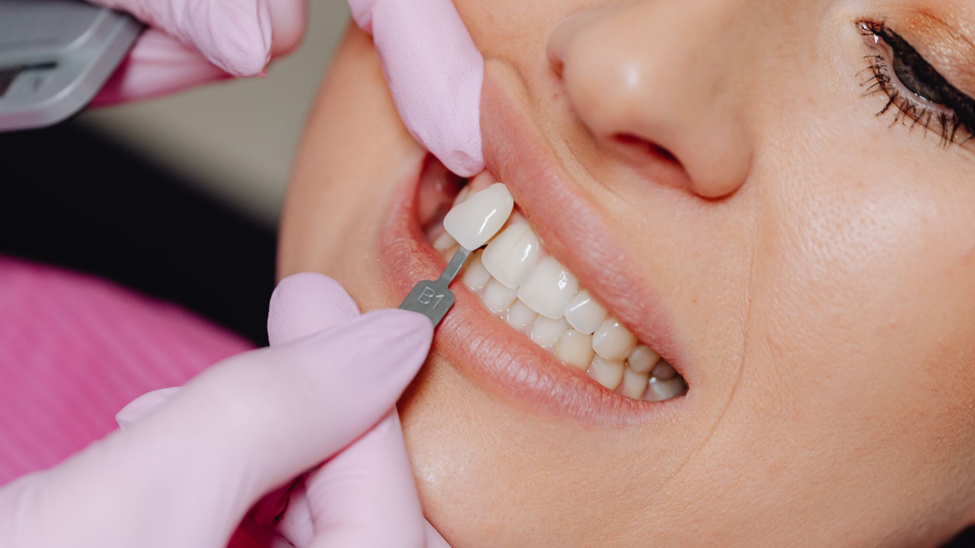 What Patients Should Know Before Whitening And Veneer Treatment in Playa Vista