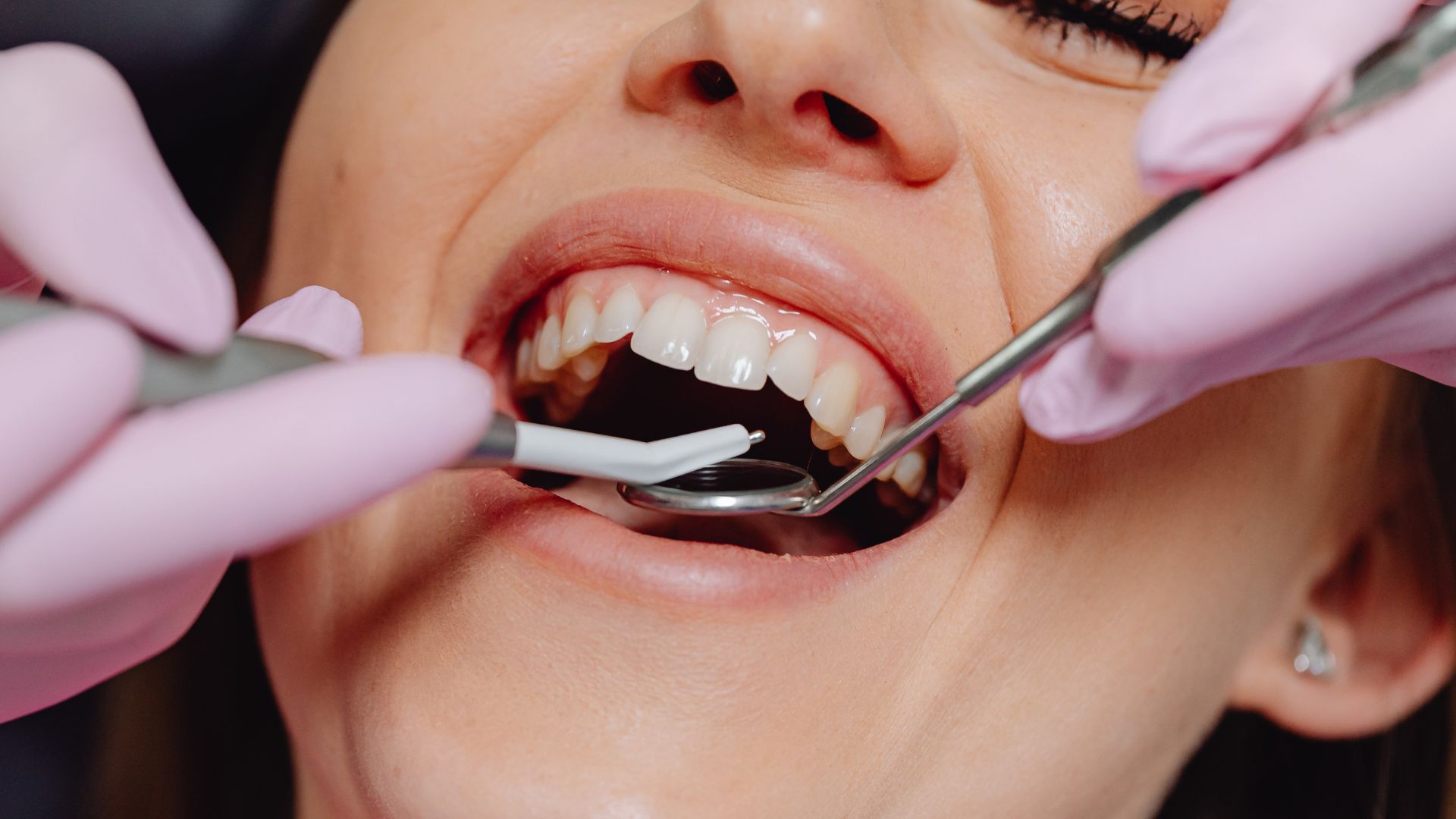 When Dental Crowns in Playa Vista May Be Recommended for You