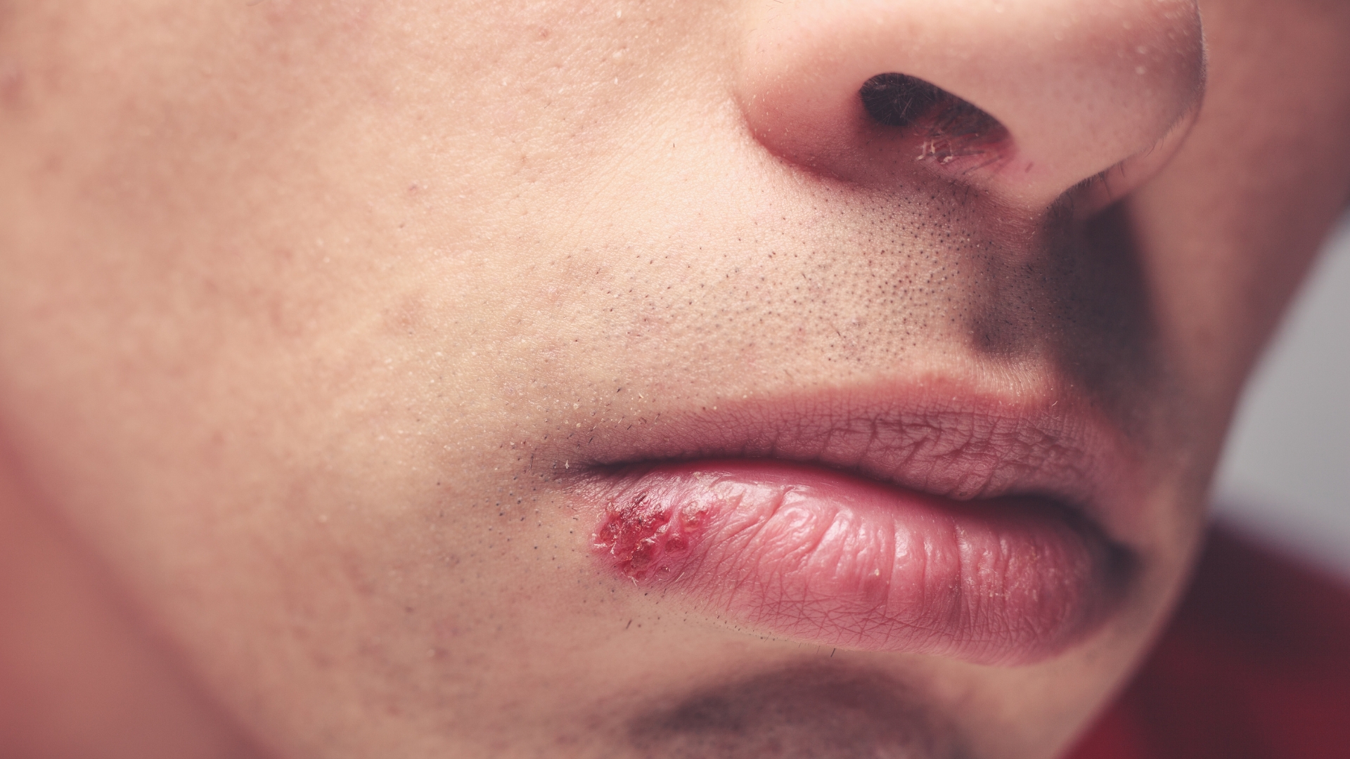 When Should You See a Playa Vista Dentist for Canker Sore Laser Treatment