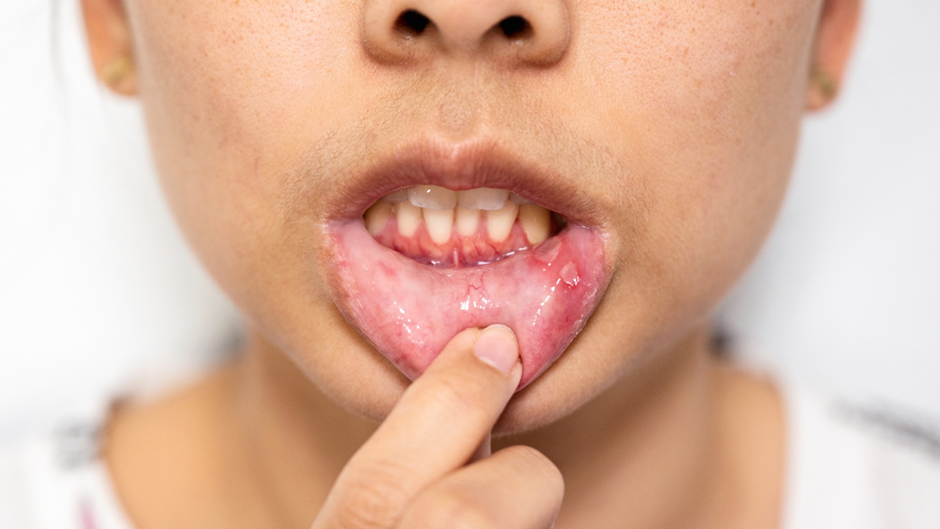 When Should You See a Playa Vista Dentist for Cold Sore Laser Treatment