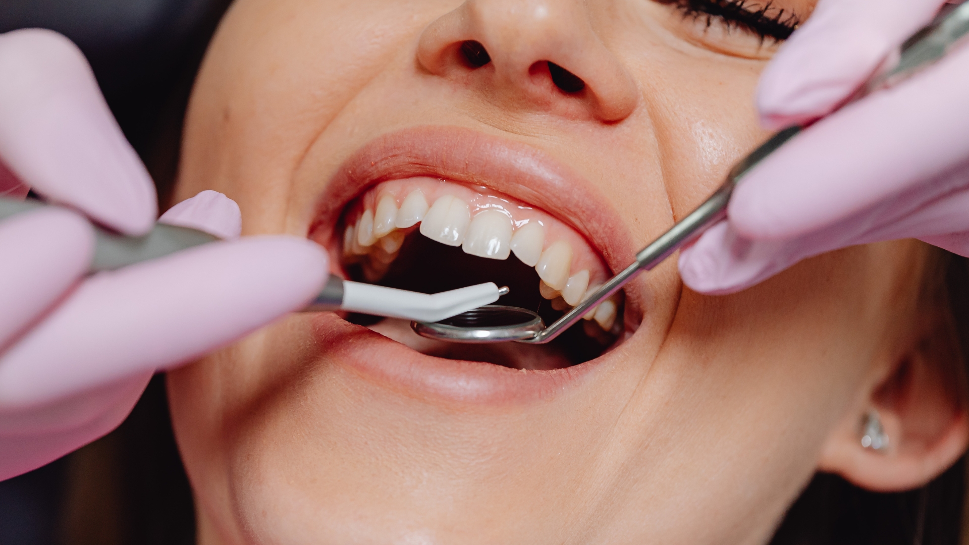 Can You Whiten Composite Bonding - Composite Bonding