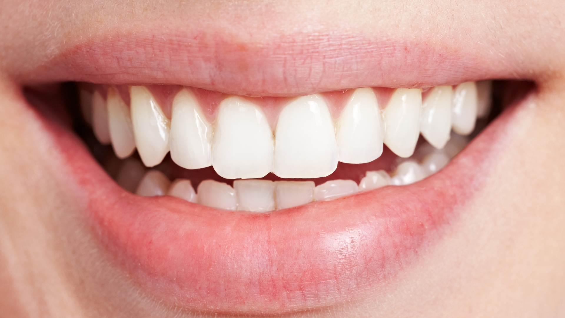 Do Veneers Ruin Your Natural Teeth in Playa Vista When Properly Planned