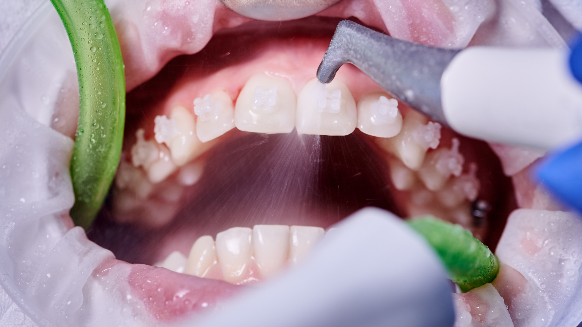 What Does a Deep Dental Cleaning Involve