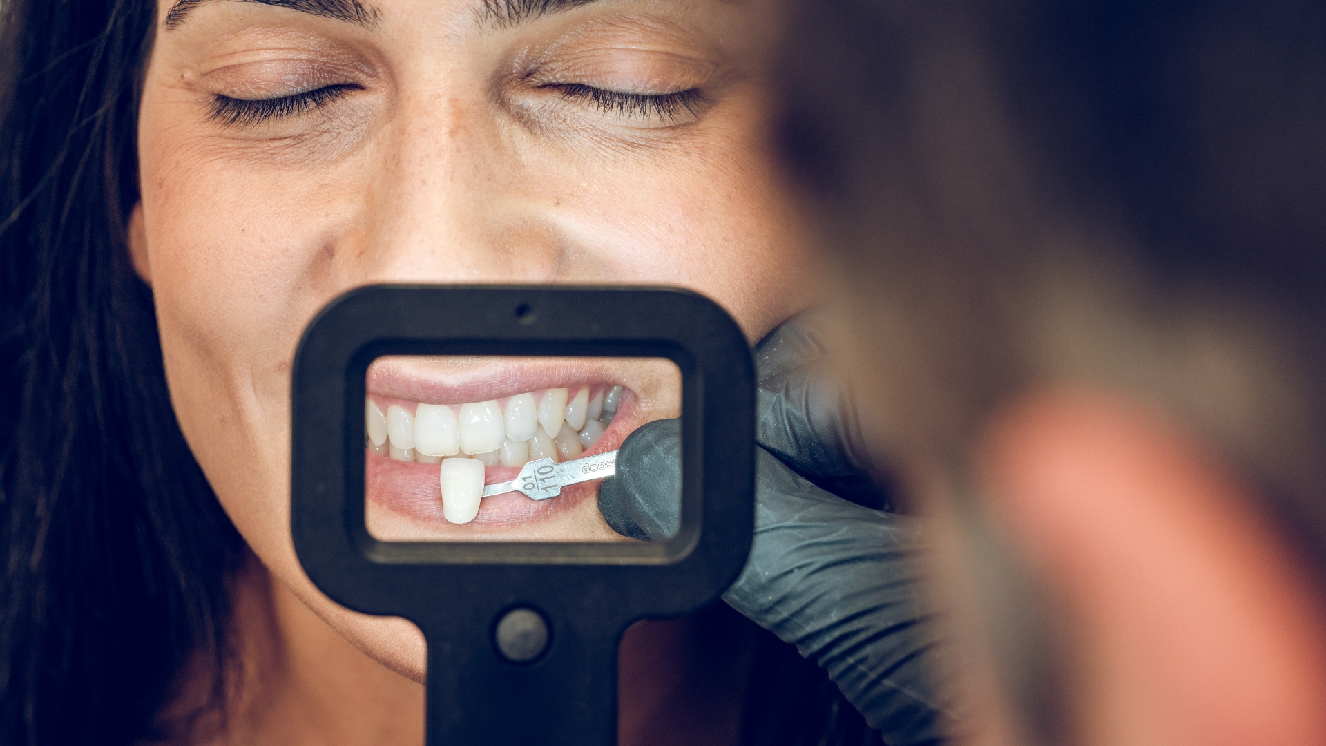 What Happens to Your Enamel When You Get Veneers in Playa Vista