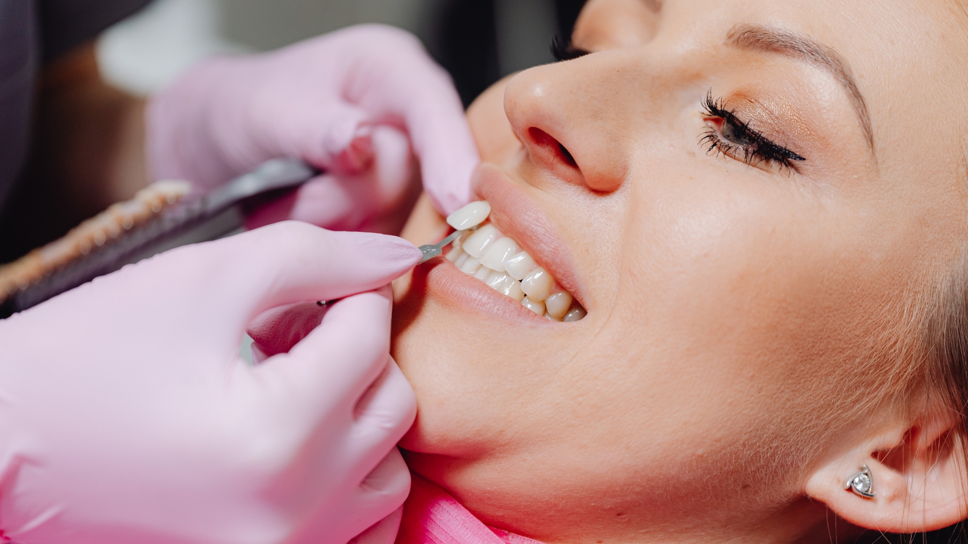 What Problems Can Develop When Veneers Are Poorly Planned