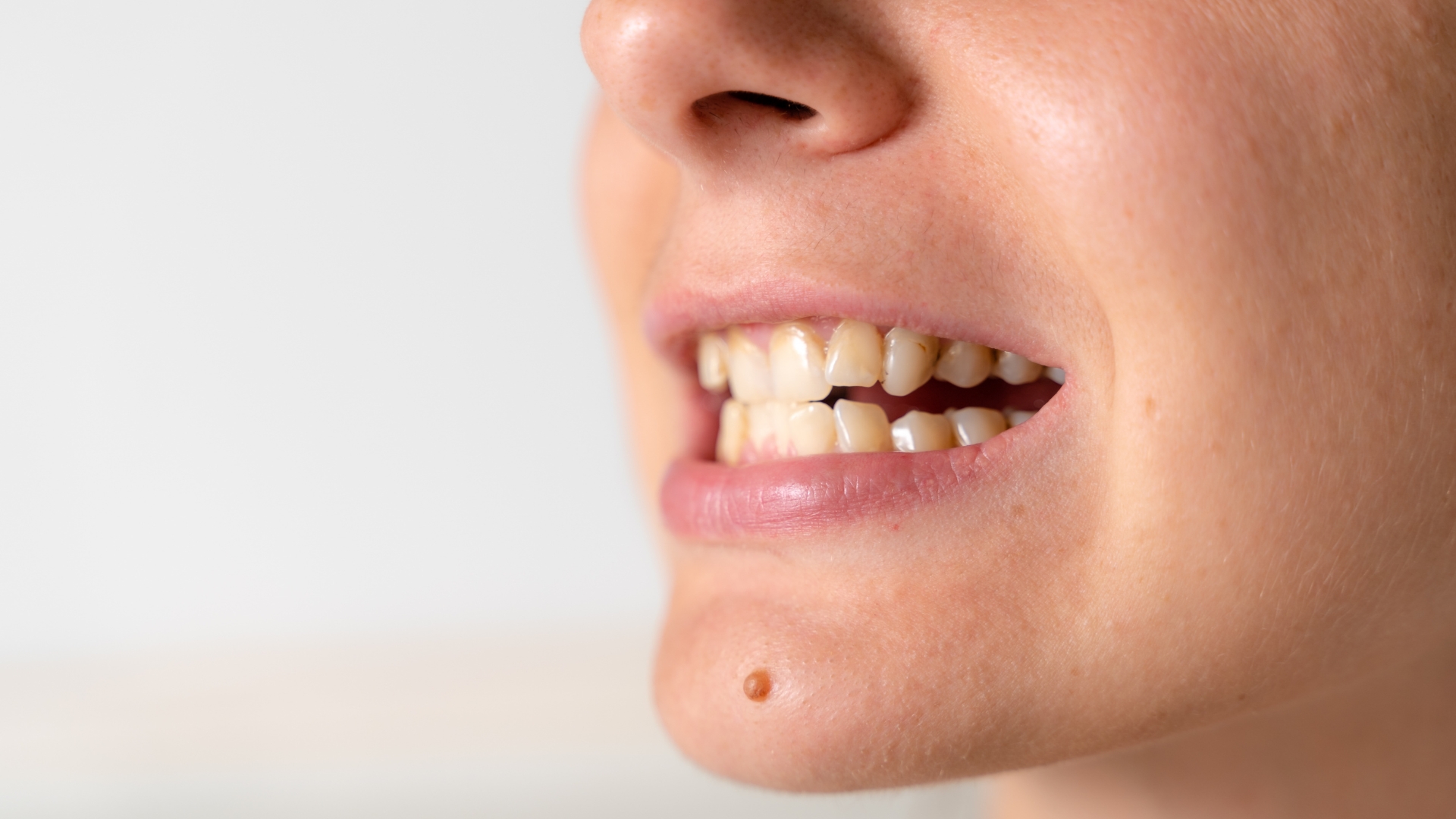 What to Know Before Choosing Dental Botox in Playa Vista