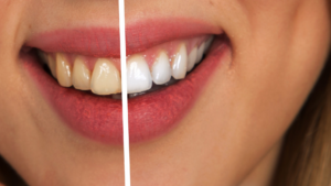 Why Teeth Whitening in Los Angeles Might Be Right for You