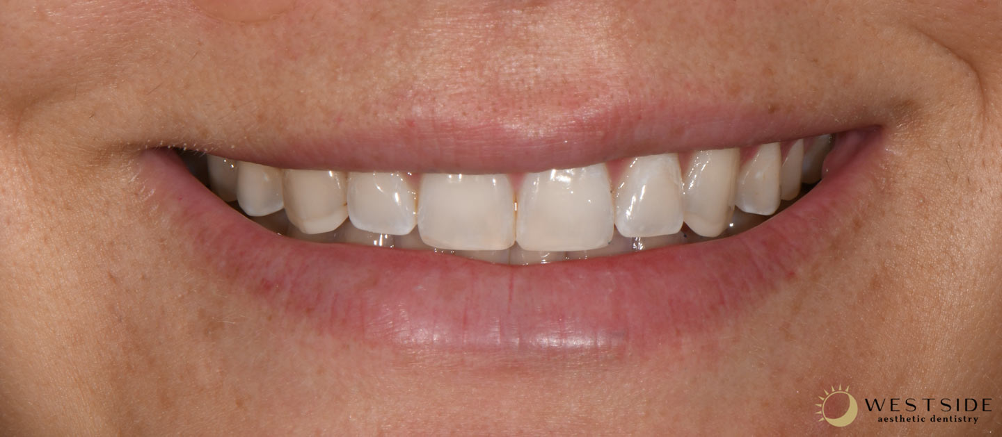 Westside Aesthetic Dentistry After