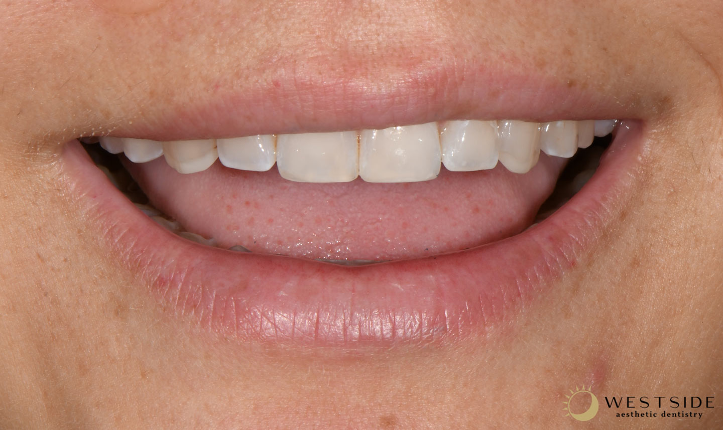 Westside Aesthetic Dentistry After 