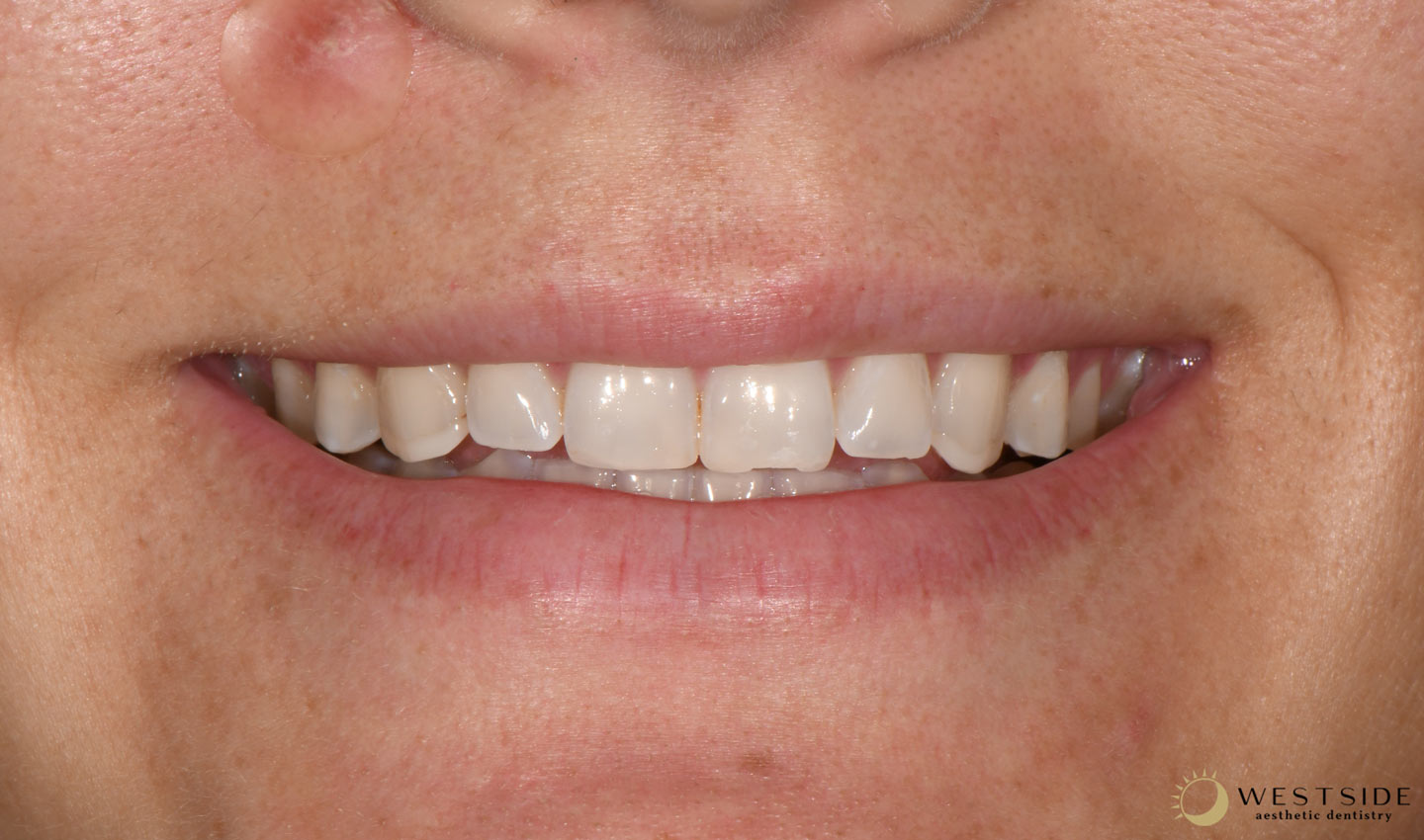 Westside Aesthetic Dentistry Before