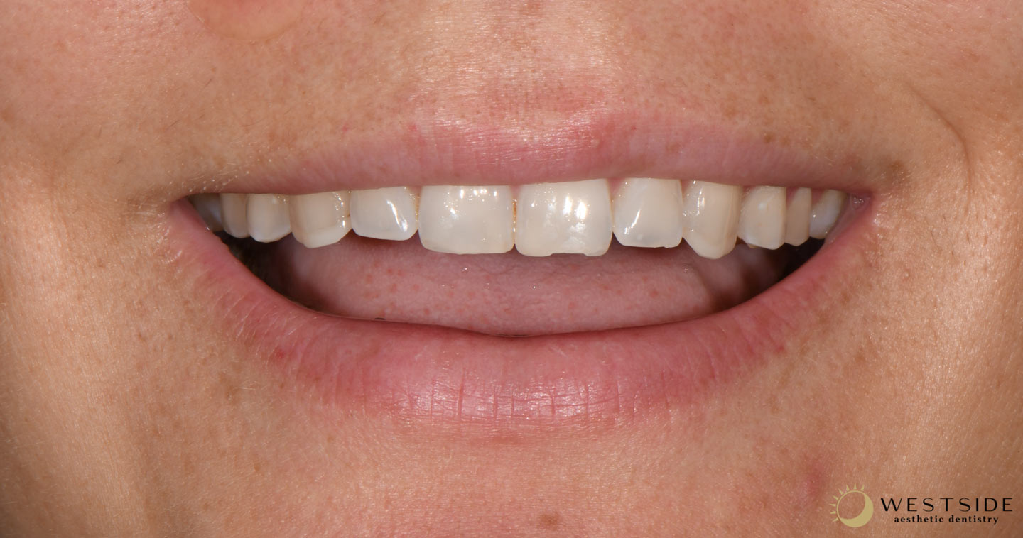 Westside Aesthetic Dentistry Before