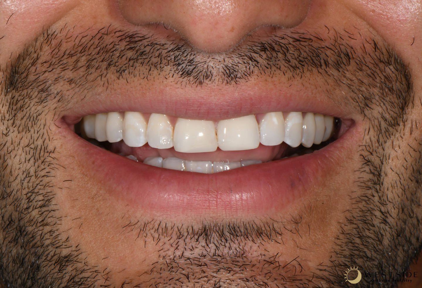 Westside Aesthetic Dentistry After