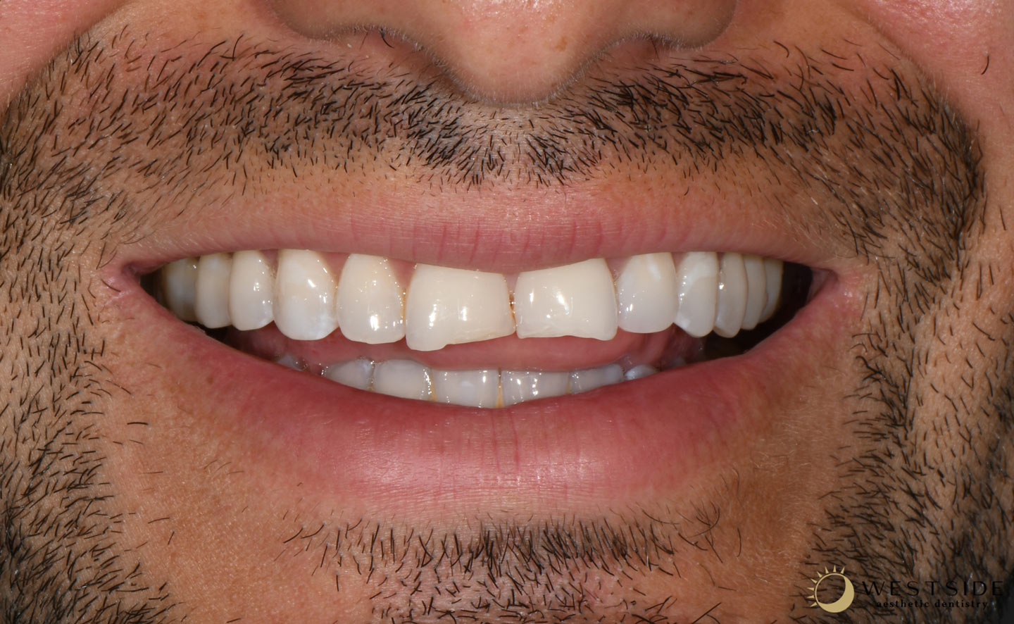 Westside Aesthetic Dentistry Before