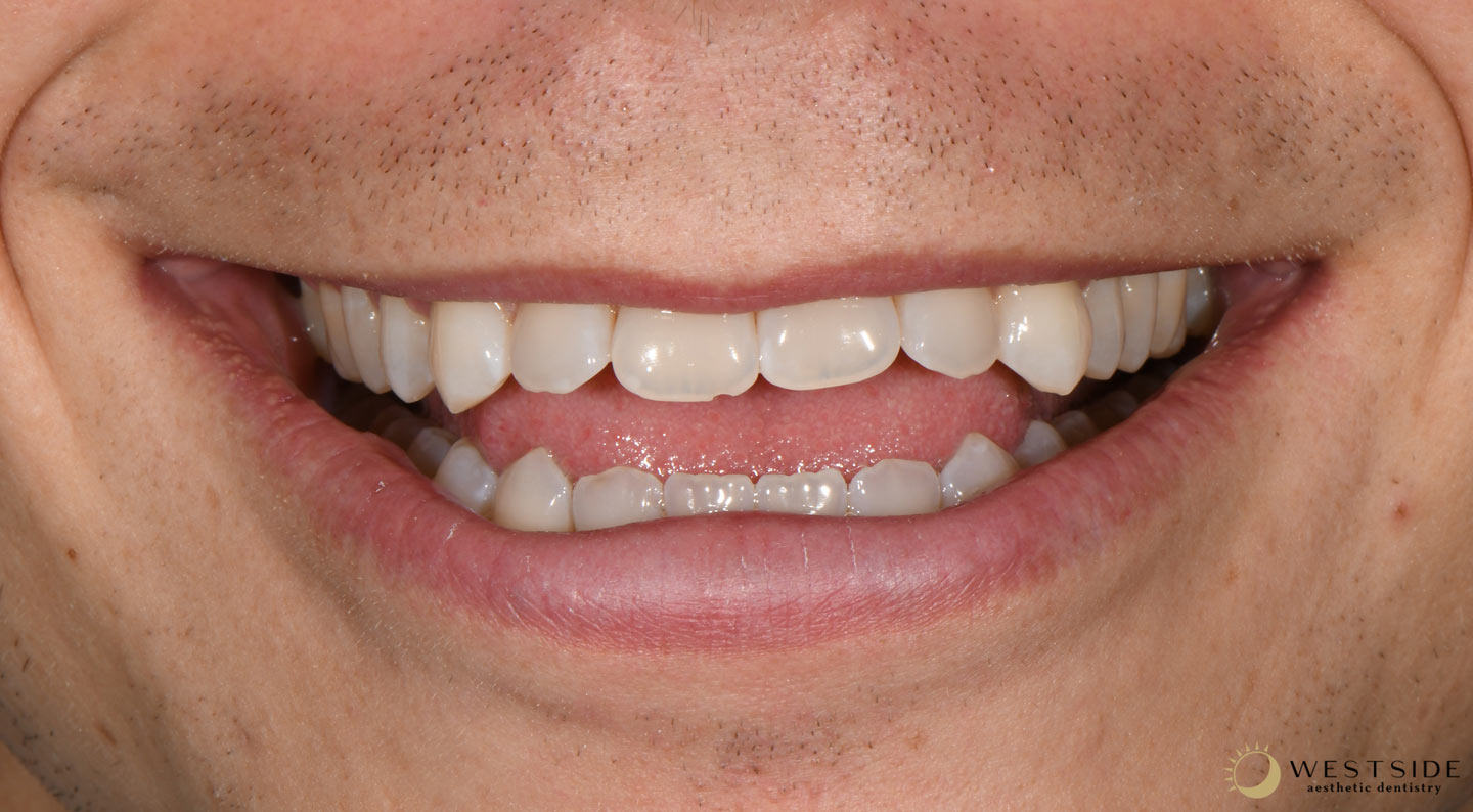 Westside Aesthetic Dentistry Before