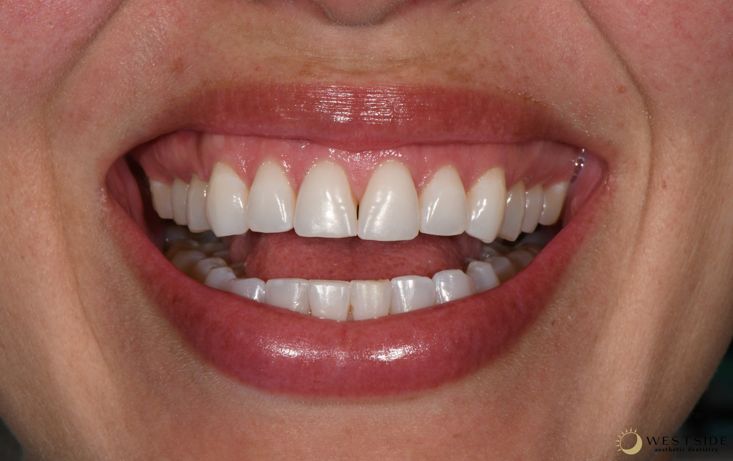 Westside Aesthetic Dentistry Before
