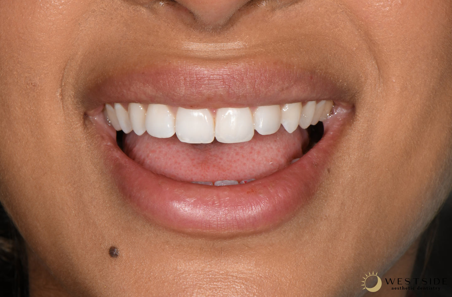 Westside Aesthetic Dentistry After