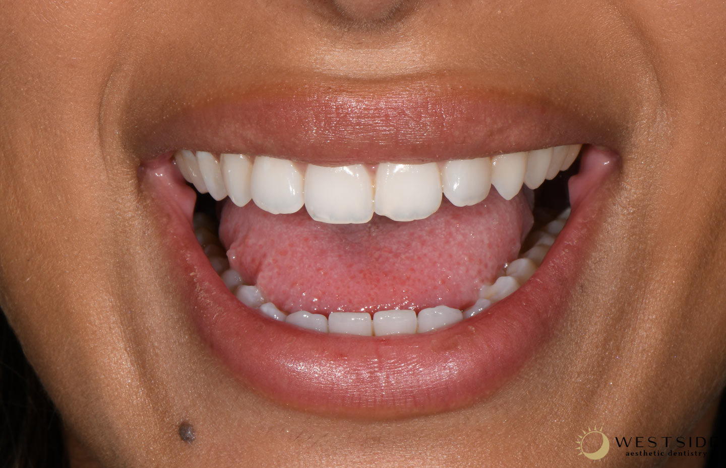Westside Aesthetic Dentistry Before